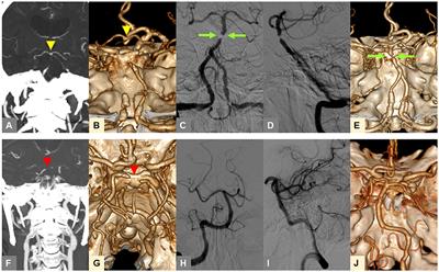 CTA-Based Truncal-Type Occlusion Is Best Matched With Postprocedural Fixed Focal Stenosis in Vertebrobasilar Occlusions